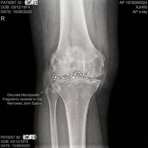 Microplastics inside joint tissue
